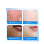 Flasteri za AKNE 1+1 GRATIS